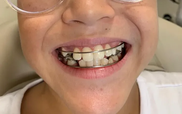 Criança sorrindo com aparelho funcional