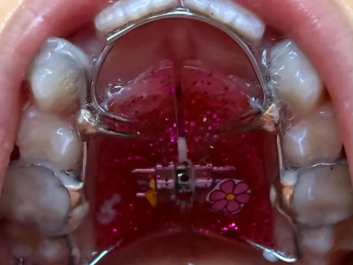 Expansor no céu da boca de uma criança