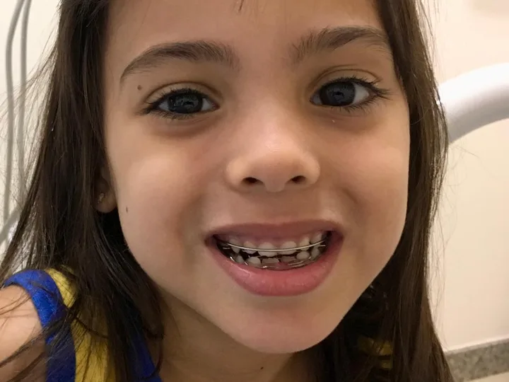 Criança sorrindo com aparelho funcional
